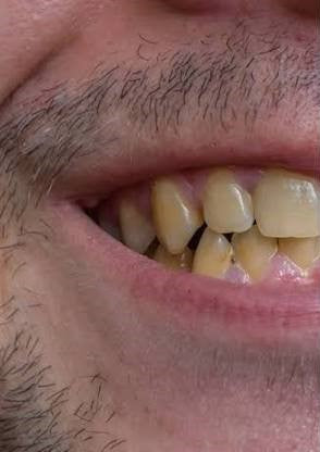 Gentle lift in surface stains over time.